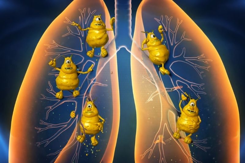 Ilustracija pluća sa nagomilanim sekretom koji sirup pomaže da se izbaci